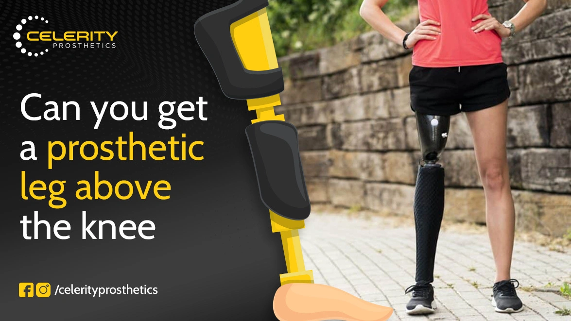 Can You Get a Prosthetic Leg Above the Knee