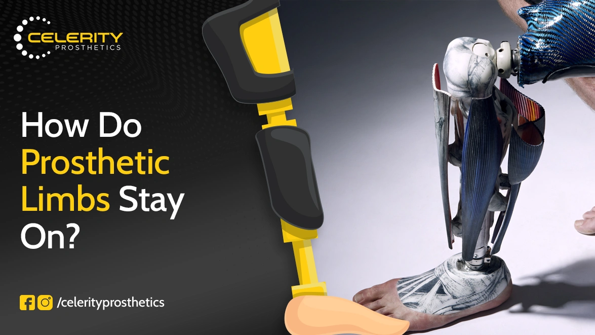 How Do Prosthetic Limbs Stay On