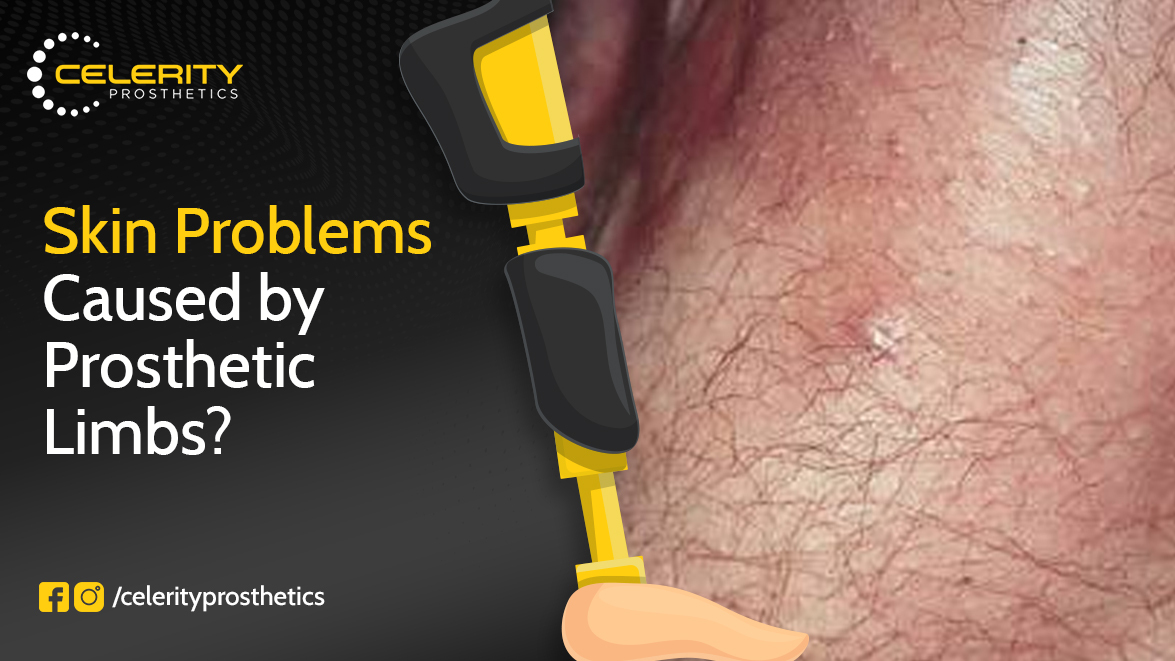 Skin Problems Caused by Prosthetic Limbs